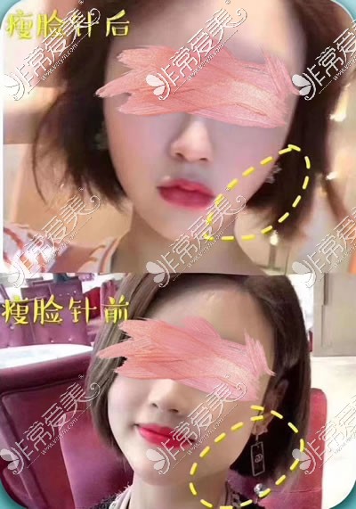 合肥恒美整形美容医院瘦脸针<span style=