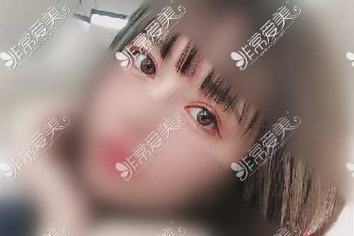 成都素美杨迪双眼皮修复<span style=