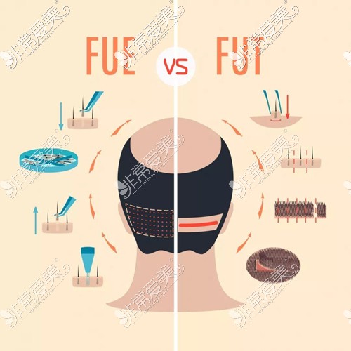FUT植发和FUE植发的区别