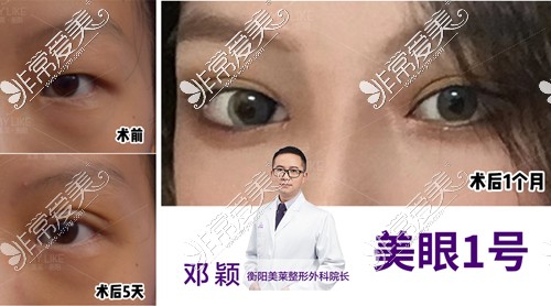 衡阳美莱邓颖技术怎么样？做鼻子、眼睛好吗？