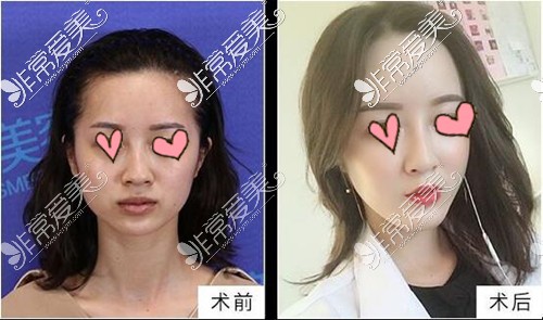 衡阳美莱邓颖技术怎么样？做鼻子、眼睛好吗？