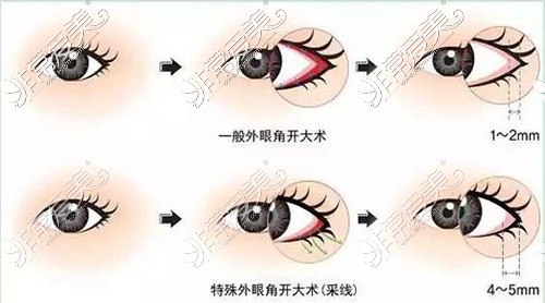 外眼角手术过程