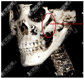 颧骨骨缝大CT照片
