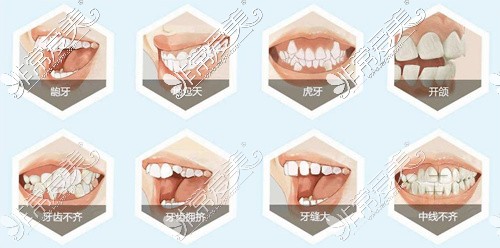 牙齿畸形分类
