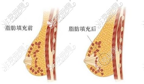 自体脂肪隆胸前后