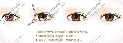 开眼角手术示意图 开眼角手术示意图