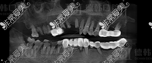 德韩口腔牙缺失种植前CT