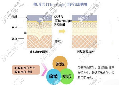 热玛吉适合多大年龄的人做？热玛吉做一次管多久？