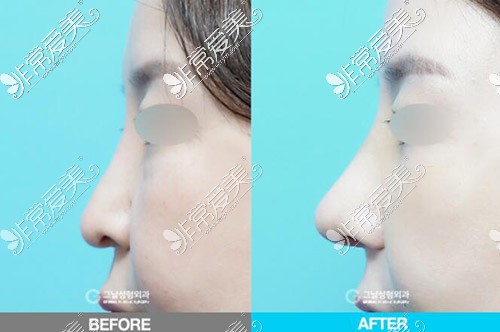 歌娜整形外科隆鼻对比图