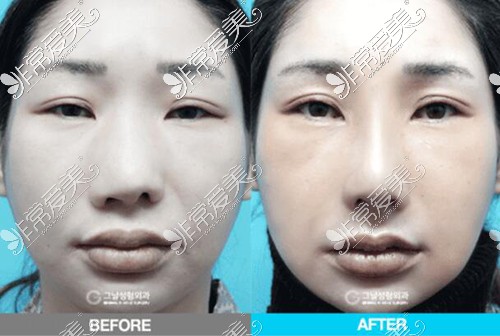 韩国歌娜整形鼻修复前后对比案例