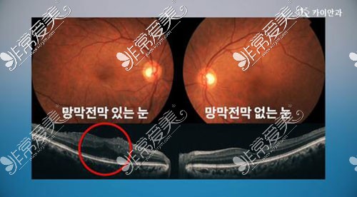 韩国凯熠眼科治疗效果
