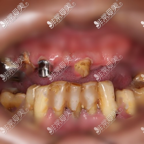 半口种植牙案例