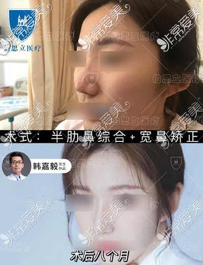 韩嘉毅鼻综合改善照片