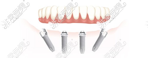 all-on-4植牙技术