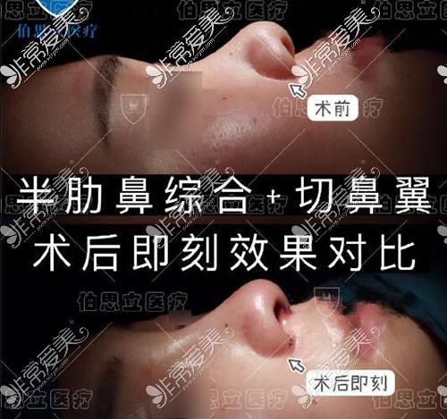 韩嘉毅隆鼻鼻翼缩小照片