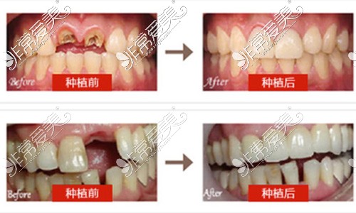 种植牙前后对比