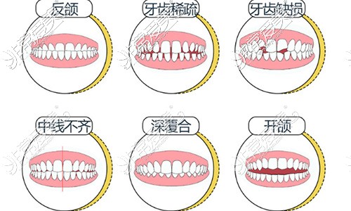 牙齿矫正适应症