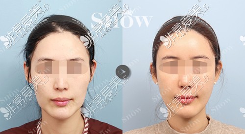 韩国SNOW整形外科面部吸脂填充