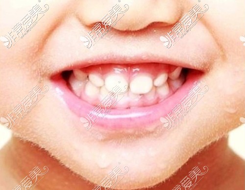 儿童健康牙齿