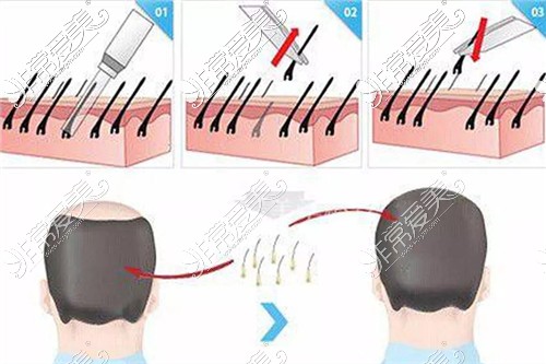 植发流程示意图