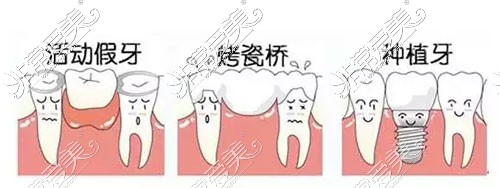 缺牙修复的几种修复方式