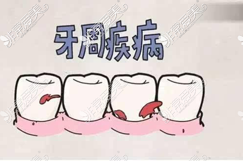 牙周疾病