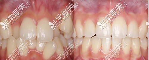 大连牙齿正畸哪家医院好?分享在大连牙齿矫正有名气的医院