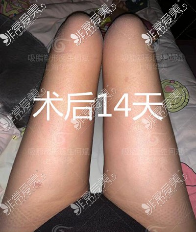 上海华美何斌大腿吸脂术后14天照片展示