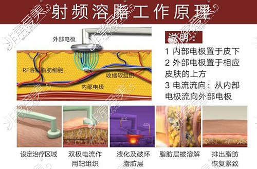 上海做面部吸脂厉害的医生汇总，还附带拿手面吸案例！