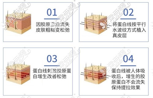 埋线提升和热玛吉哪个更好？哪个抗衰老作用好？