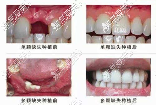 广州柏德口腔种植牙怎么样?公开柏德口腔案例和价格表