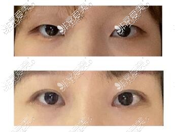 韩国大眼睛整形医院双眼皮手术