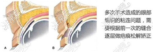 双眼皮修复方式