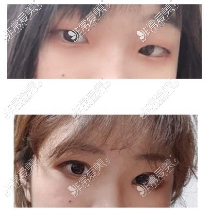 韩国大眼睛双眼皮手术案例