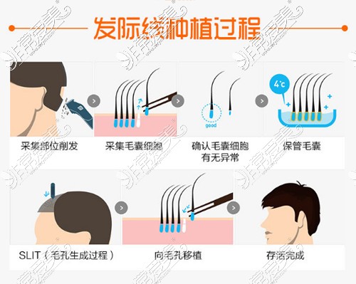 义乌植发医院在哪里？分享义乌好的植发医院！