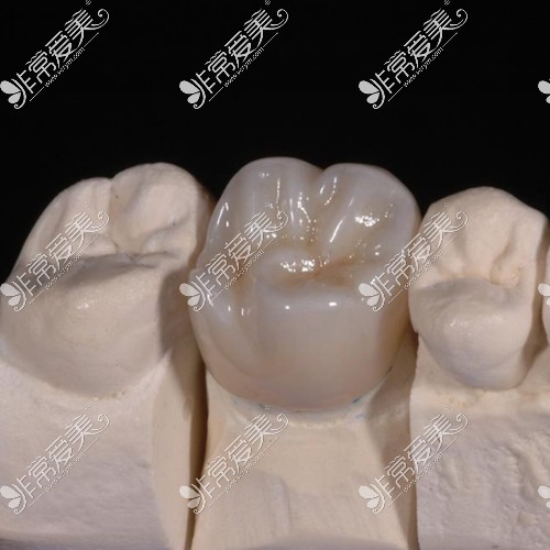 牙冠修复模型图