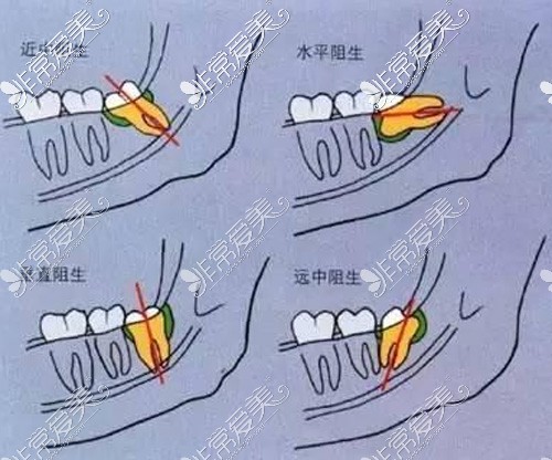 几种智齿阻生情况展示