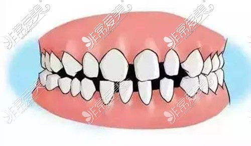 牙齿牙缝大牙齿稀疏怎么修复？可以做矫正吗？