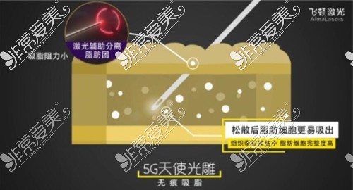 5G天使光雕和传统吸脂比有哪些优势?郑州哪里能做5G天使光雕