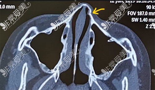 鼻骨CT照片示意图