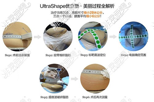 Ultrashape优立塑溶脂技术
