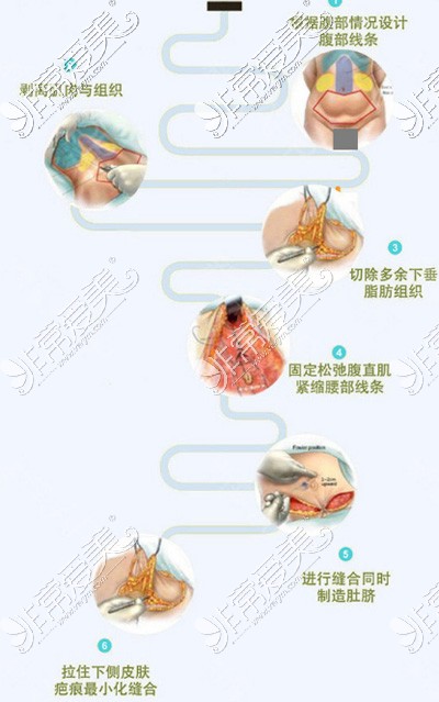 腹壁成形术手术过程展示