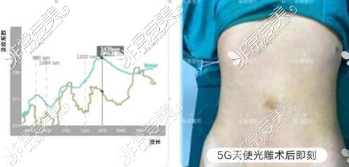 5g天使光雕吸脂术价格表公布,揭秘5g天使光雕一个部位多少钱