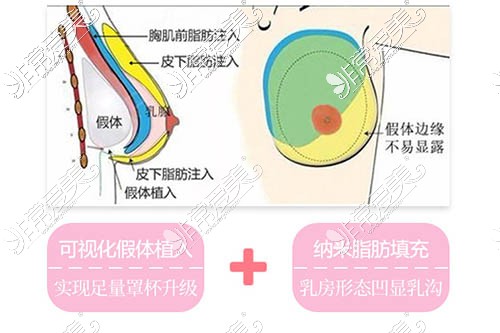 隆胸假体再加脂肪填充更好吗?杭州做复合隆胸30000元够不?