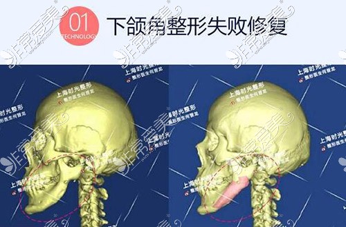 下頜角失敗修復方法