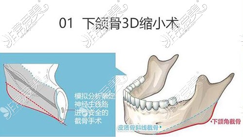 下颌骨3D缩小术卡通图