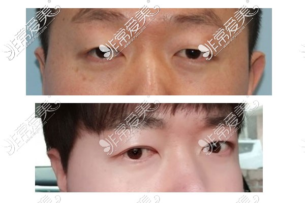 男生小眼睛双眼皮手术案例