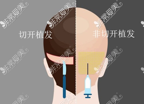 想知道植发1000单位多少钱?根据部位、方式不同来收取!