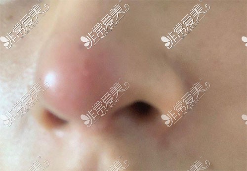 鼻综合后遗症图片