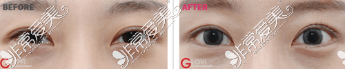 韩国歌柔飞整形外科双眼皮修复案例